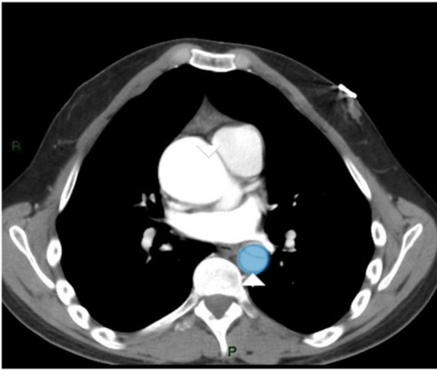 <p>Label the highlighted pathology in the image below</p>