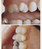 <ul><li><p>small, round enamel extensions forming extra cusps</p></li><li><p>results from an enamel knot malformation</p></li><li><p>common on molars</p></li></ul><p></p>