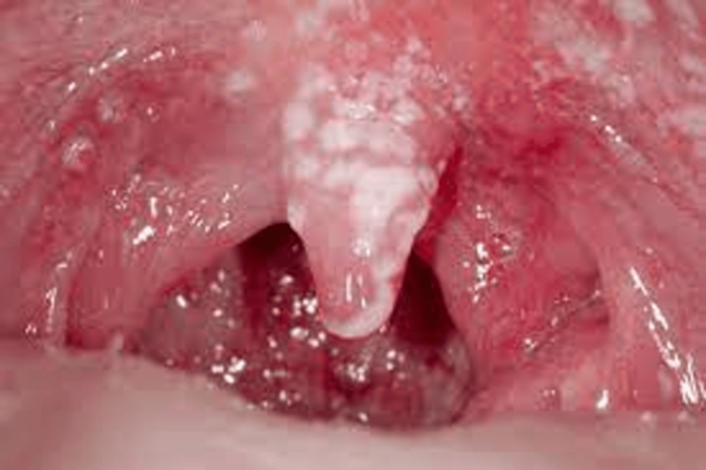 <p>-Erythema or white spots</p><p>-Antifungal treatment</p>