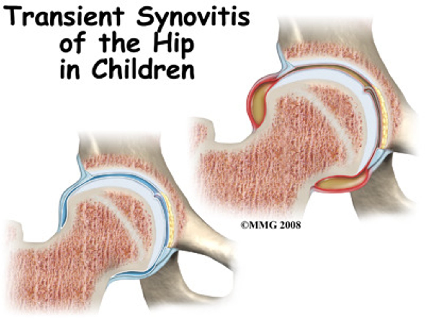 <p>inflammation of the synovial membrane that results in swelling and pain of the affected joint</p><p>present in RA</p>