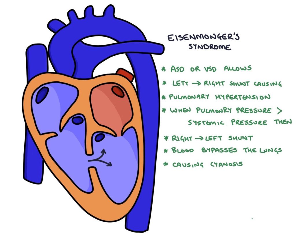 <ul><li><p>Pressure of the RV becomes higher than the LV <u>causing the shunt to reverse</u></p></li><li><p>C.S</p><ul><li><p>Are caused by <u>unoxygenated blood being pumped</u> into the LV and then <u>around the body</u> (bc pressure in RV&gt;LV)</p></li><li><p>Cyanosis</p><ul><li><p>Lethargy</p></li><li><p>Exercise intolerance</p></li><li><p>Collapse</p></li><li><p>Erythrocytosis (Higher # of RBCs)</p></li></ul></li></ul></li></ul><p></p><p>Image is wrong, just using it to associate</p>