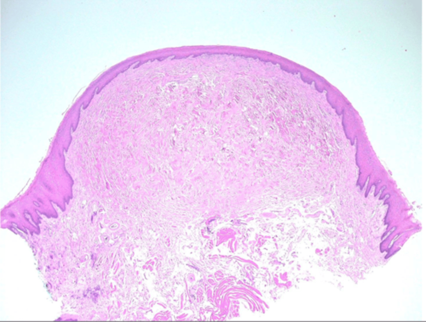 <p>Nodular mass of fibrous connective tissue covered by stratified</p><p>squamous epithelium</p><p>• Surface may exhibit hyperkeratosis from secondary trauma</p>