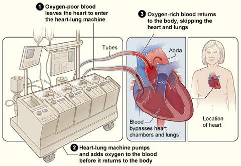 <p>What are <strong>heart-lung machines? What do they do?</strong></p>