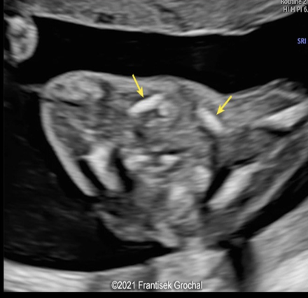 <p><strong>cleidocranial dysplasia</strong> is an autosomal <strong>dominant</strong> condition characterized by</p><p>a) lack of formation of the ribs + vertebral processes</p><p>b) lack of formation of the long bones</p><p>c) clavicular aplasia or hypoplasia [short, straight]</p><p>d) cloverleaf skull + cleft palate</p>