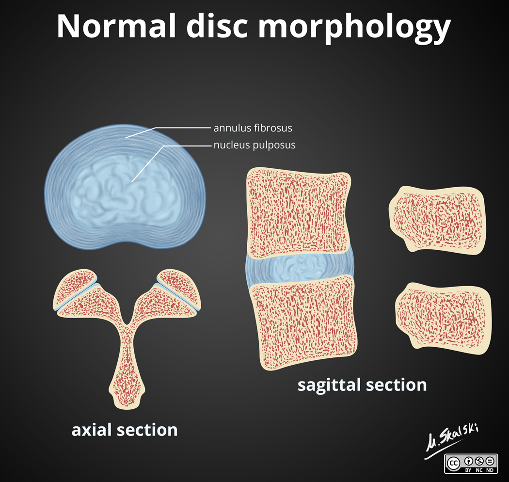 <p>(Inter)Verterbral Discs </p>