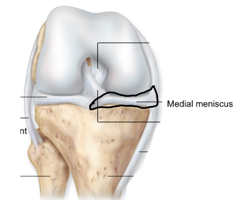 <p>medial meniscus</p>