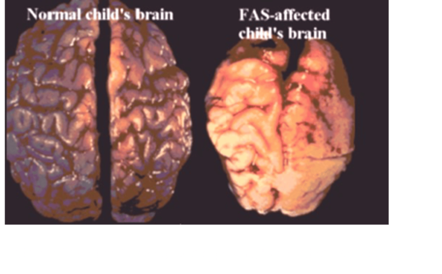 <p>Drug Abuse</p><p>-alcohol and psychoactive drugs</p><p>-causes wet brain syndrome and reduces thiamine</p><p>Poor Circulation</p><p>-impairs blood flow = impairs brain circulation</p><p>-slows down thought</p><p>Viruses</p><p>-HIV + mad cow disease destroy neurons</p><p>Genes</p><p>-Alzheimer's disease is autosomal dominant which destroys the brain in middle age</p><p>-Huntington's Chorea which creates severe neurocognitive disorders midlife</p><p>Traumatic Brain Injury (TBI)</p><p>-blow to the skull, extremely loud noise, or a rapid acceleration of the head</p>