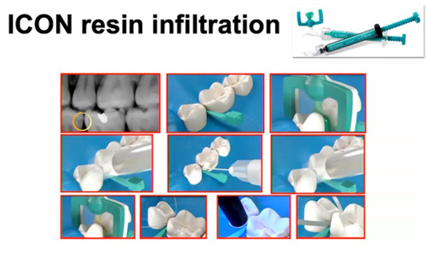 <p>acid/etch on white spots to light refract</p>