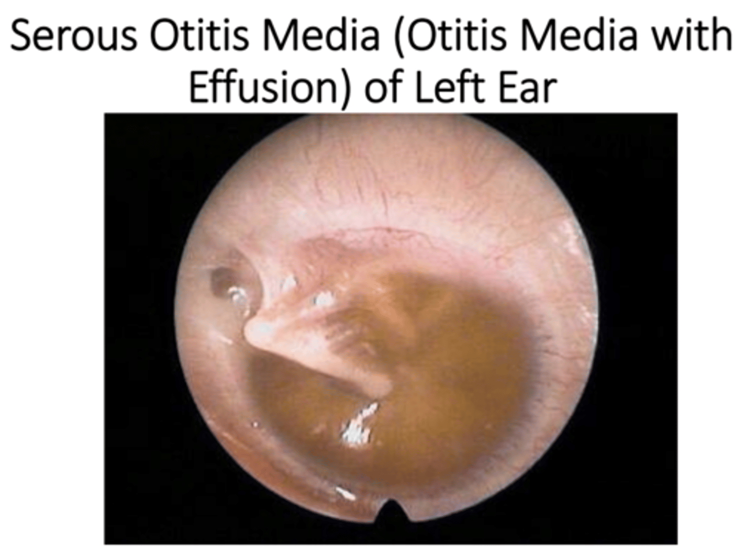 <p>• Fever, if any, is lower</p><p>• Pain is low‐grade or absent</p><p>• Child appears less sick, less fussy, eats better</p><p>• May be fluid behind tympanic membrane, and bubbles, but less redness and no pus</p>