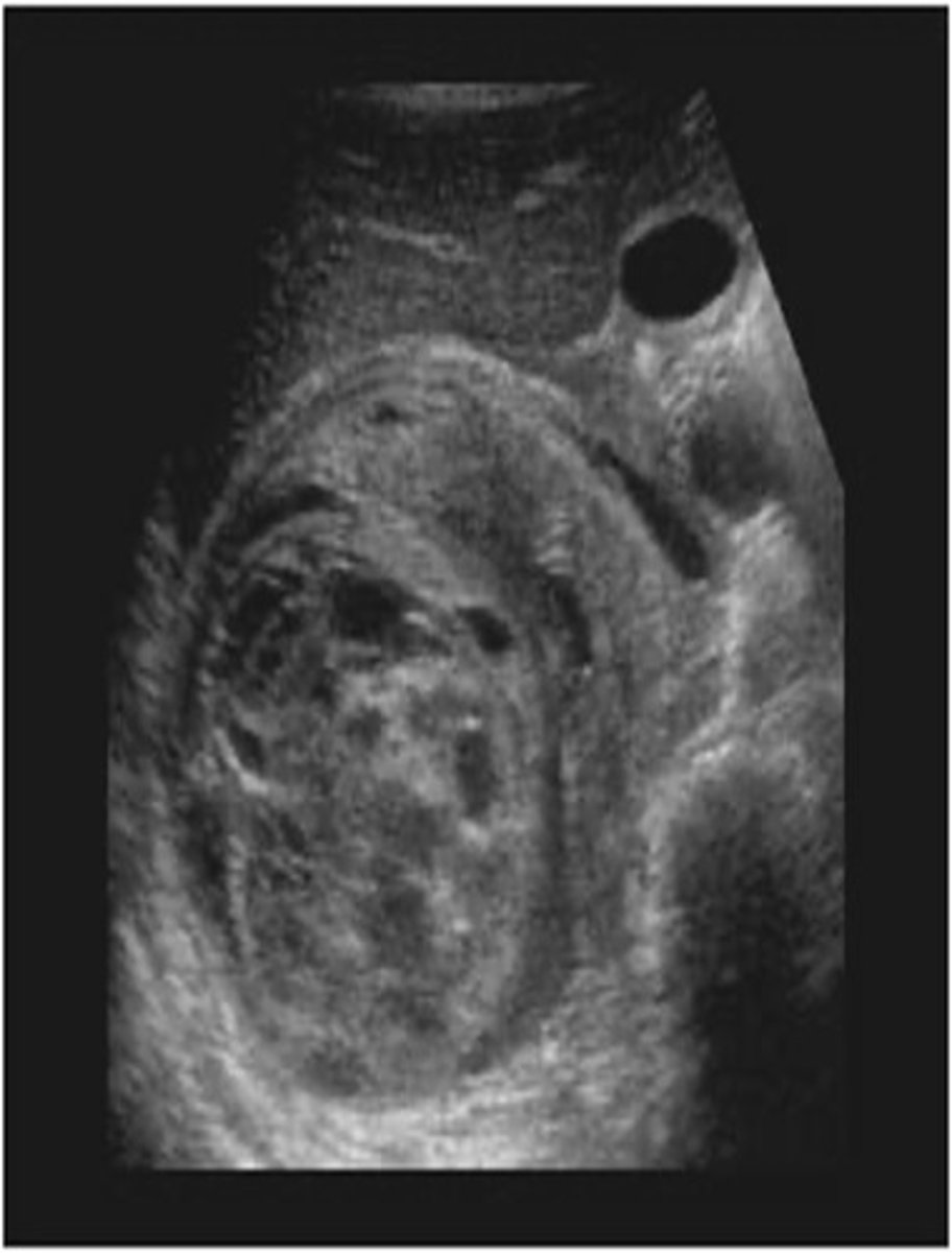 <p>- abdominal flank mass</p><p>- hematuria</p><p>- fever</p><p>- anorexia</p>