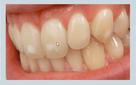 <p>abnormal colour of teeth - what causes <strong>mottling</strong>?</p>