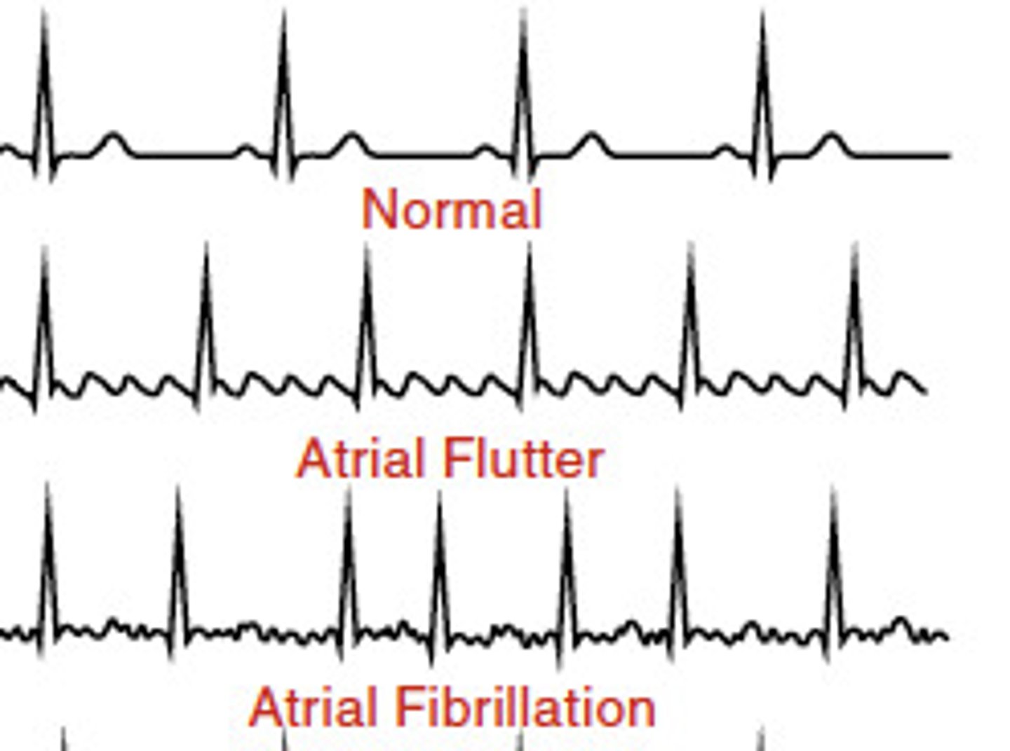 <p>b. a fib </p><p>this is a common paroxysmal supraventricular arrhythmia (PSVT) </p>