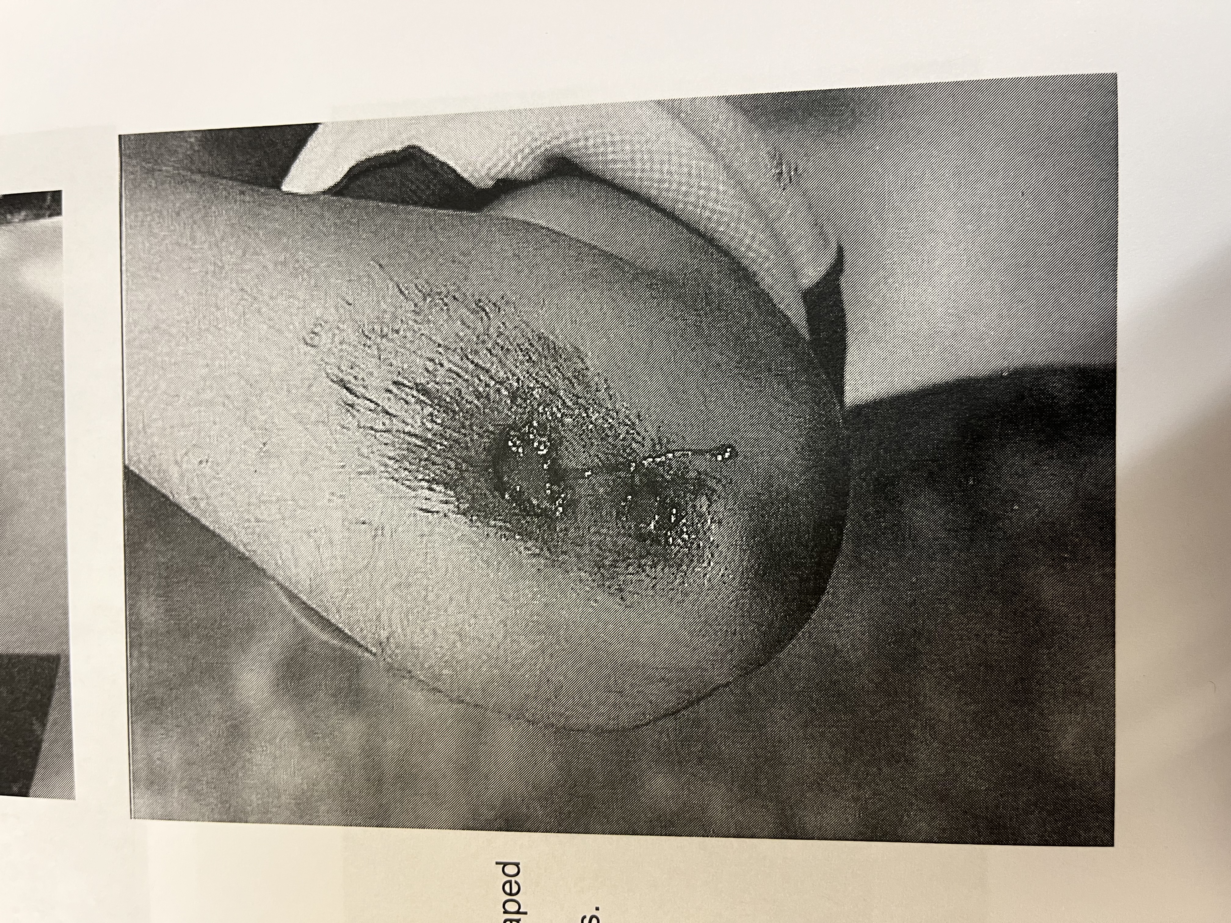 <p>wound were the surface layer of skin (epidermis) is scraped away</p>