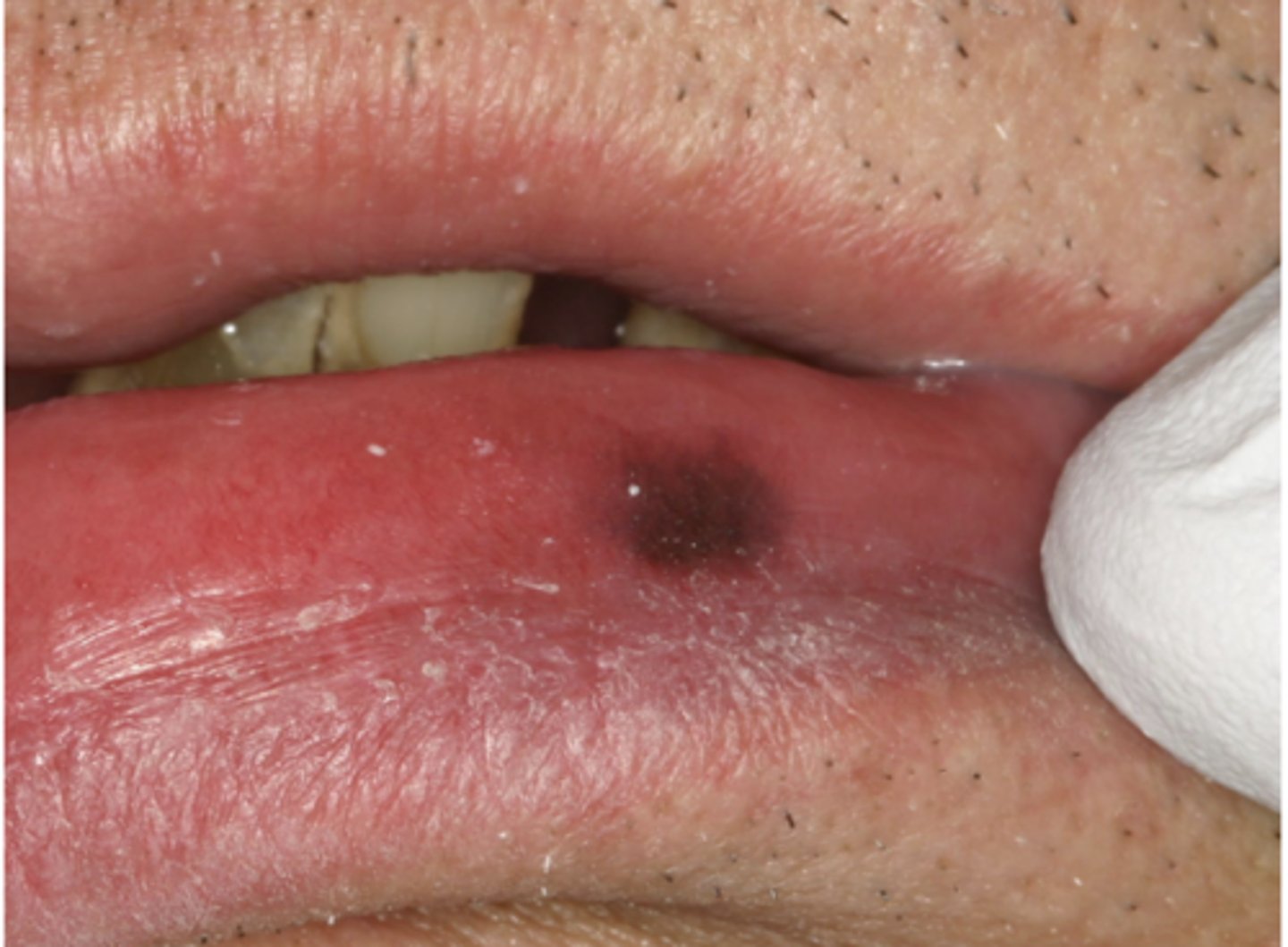 <p>What type of pigmented lesion?</p>