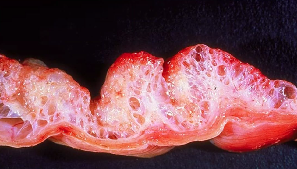 <p>What is the condition?</p><p>A-Emphysematous cystitis</p><p>B-Necrotizing cystitis</p><p>C-Transition cell carcinoma</p><p>D-Squamous cell carcinoma</p>