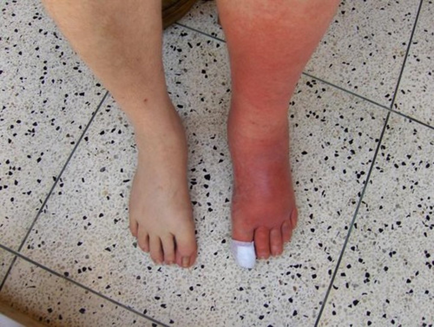 <p>diagnose this image</p><p>Skin erythema, edema, and warmth-->Deeper dermis and SubQ fat--> borders are NOT defined</p>