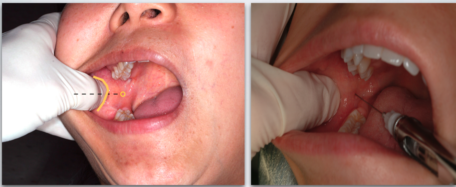 <ol><li><p>Place thumb at the coronoid notch, parallel to the plane of occlusion </p></li><li><p>The imaginary line begin at the midpoint of the notch and terminate at the deepest part of the pterygomandibular raphe</p></li><li><p>Place finger in the coronoid notch (greatest concavity on anterior border of the ramus) </p></li><li><p>Continue the imaginary line to the deepest part of the pterygomandibular raphe.</p></li><li><p>Needle insertion lies 3/4th of the anteroposterior distance of this line</p></li></ol><img src="https://knowt-user-attachments.s3.amazonaws.com/d43ecb58-626e-4ea5-9d3a-5cce586e0963.png" data-width="100%" data-align="center"><p></p>