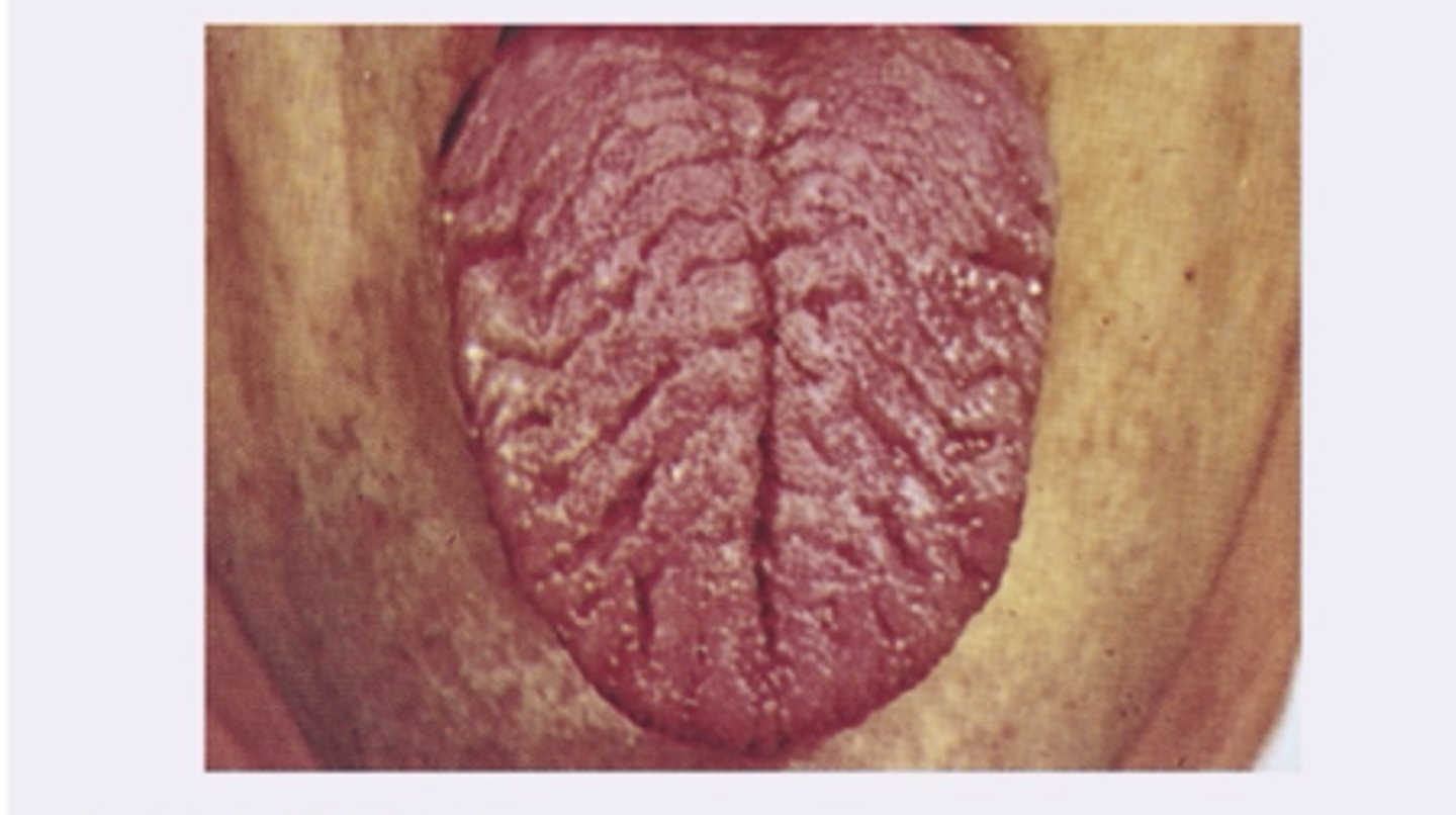 <p>Fissured tongue is common in _____ patients</p>