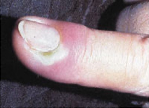 <p>acute infx of nail fold</p>