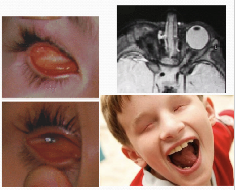 <p>It can cause the complete loss of an eye (anophthalmia). This is due to the lack of lens formation, which adversely affects the development of additional ocular structures.</p>