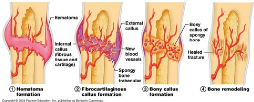 four stages of healing in a fracture
