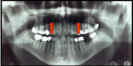 <ul><li><p>is the space between the palate and the tongue.​</p></li><li><p>appears as a horizontal well-defined radiolucent band located superior to the apices of the maxillary teeth.</p></li></ul><p></p>