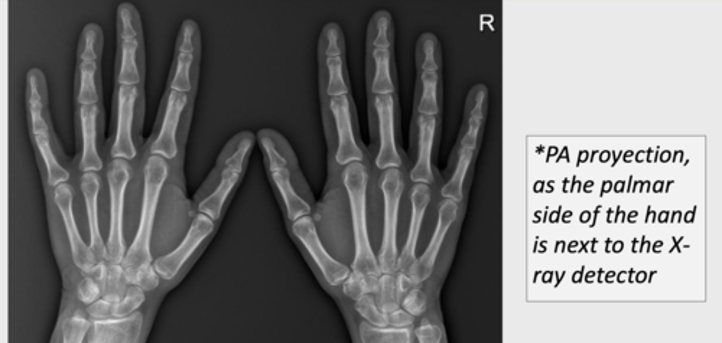 <p>if thumb is looking out its AP</p>