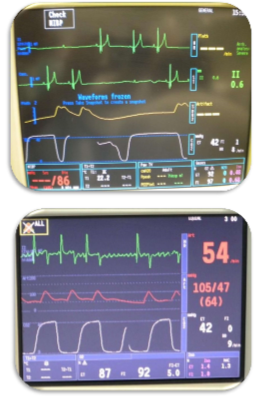 <ul><li><p>AV block</p><ul><li><p>Define cause</p></li><li><p>Atropine or glycopyrrolate</p></li></ul></li><li><p>Atrial fibrillation</p><ul><li><p>Unusual to develop during anaesthesia</p></li></ul></li></ul><p></p>