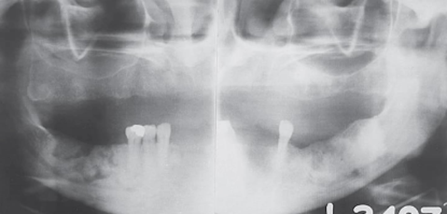 <p>-shows irregular radiopaque masses in both the left and right posterior mandible</p><p>-disordered cementum and bone deposition</p><p>-involves multiple quadrants in the posterior maxilla and mandible</p><p>-most often occurs in black women older than 40 years of age</p>