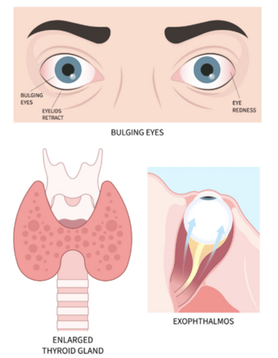 <p>diffuse thyroid enlargement</p>