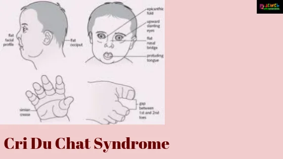 <p>Cri-du-chat is caused by a ______ of terminal end of the ____ arm of chromosome _. Phenotypes include distinctive cry, low birth weight, microcephaly, hypertelorism, round face, micrognathia, and severe cognitive impairment </p>