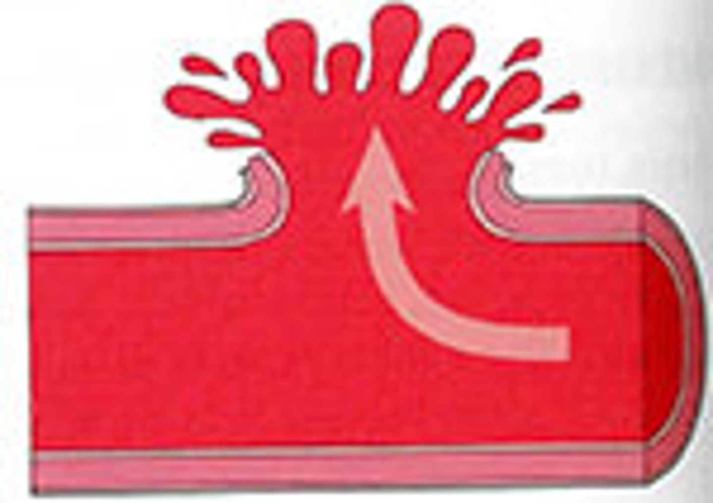 <p>blood vessel bursts and allows blood to seep into brain tissue</p>