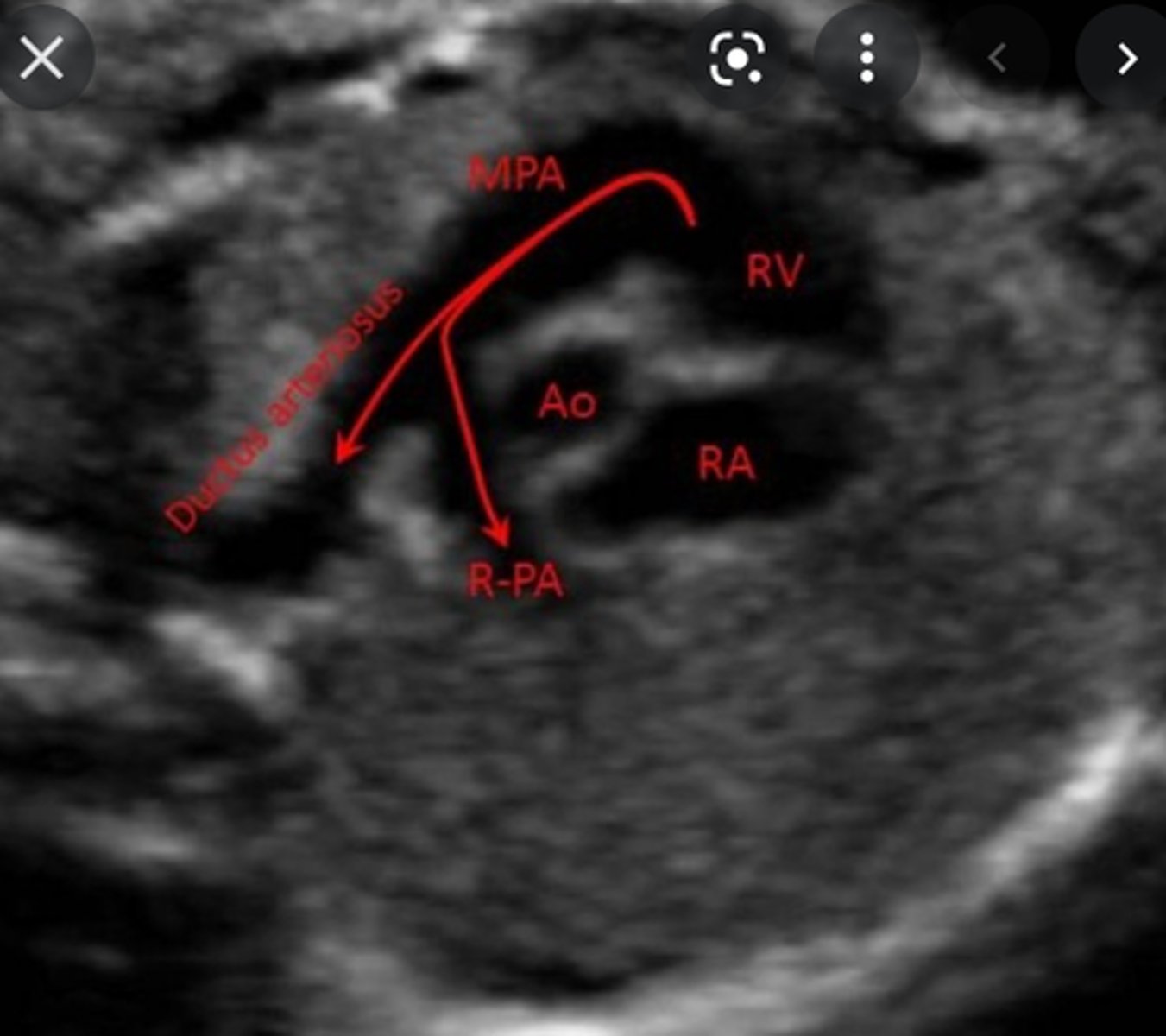 <p>connects right ventricle to pulmonary artery</p>