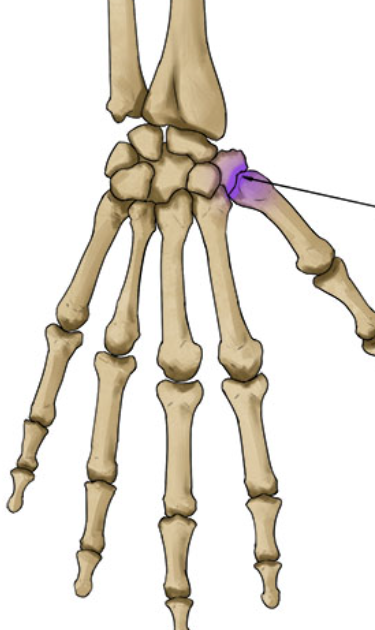 <p>Concave/convex surfaces; ex: thumb CMC joint.</p>