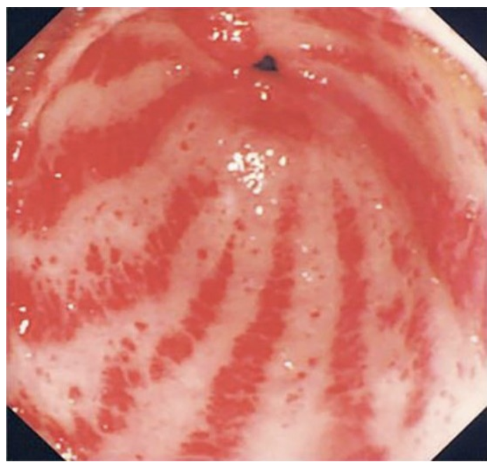 <p>A 76-year-old woman, known to have multiple medical problems, was admitted for further work up for symptomatic anemia. Patient was complaining of fatigability, dizziness, and occasional black stool for about six months before admission. No history of hematemesis or rectal bleeding was noted. Patient’s past medical history was significant for hypertension, dyslipidemia, and systemic sclerosis. Upon examination, he looked pale and lethargic but with stable vital signs and without postural hypotension. Laboratory studies revealed a hemoglobin of 7.6 g/dL (normal: 10-16 g/dL) and hematocrit of 24% (normal: 36-48%). White blood cell and platelet counts were normal. Serum iron study showed low serum iron levels. Her renal and liver functions, and coagulation panel were within normal limits. The endoscopic appearance of her stomach is shown in the attached figure. Which of the following is the most likely diagnosis?</p><p></p><p>Gastric antral vascular ectasia</p><p>&nbsp;</p><p>Portal hypertensive gastropathy</p><p>&nbsp;</p><p>Dieulafoy lesion</p><p>&nbsp;</p><p>Esophageal varices</p><p>&nbsp;</p><p>Mallory Weiss syndrome</p>