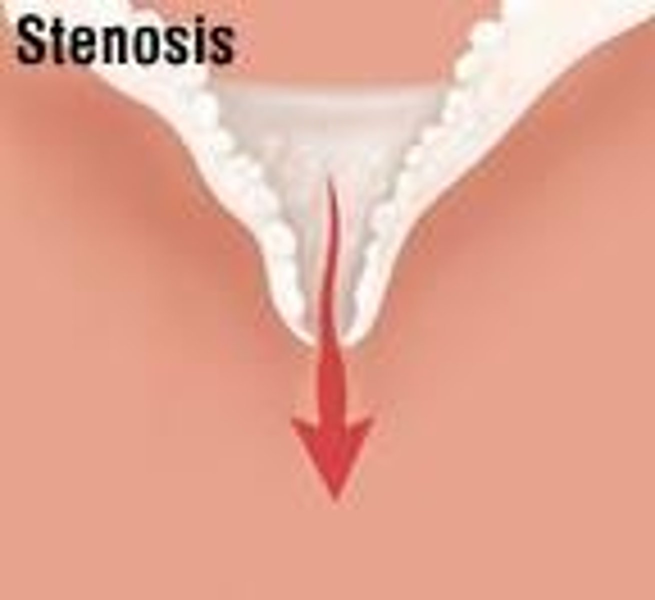 <p>-NARROWING of a heart valve, restricting forward blood flow</p><p>-less blood is flowing through the valve</p><p>-decreases cardiac output and increases workload which causes hypertrophy</p><p>-atresia: failure to open valve, which may</p><p>accompany stenosis</p>