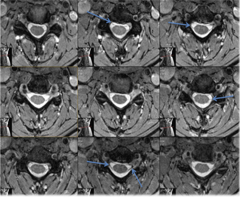 <p>both dorsal and ventral nerve roots. (blue arrows) </p>