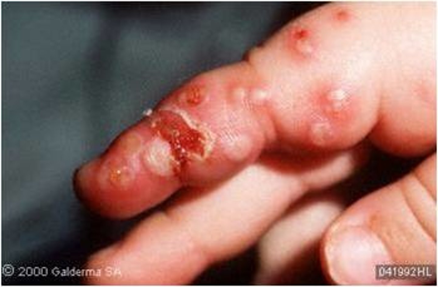 <p>HSV1/2 skin infection<br>Enters via skin abrasion<br>Causes vesicular lesions of hands/fingers</p>