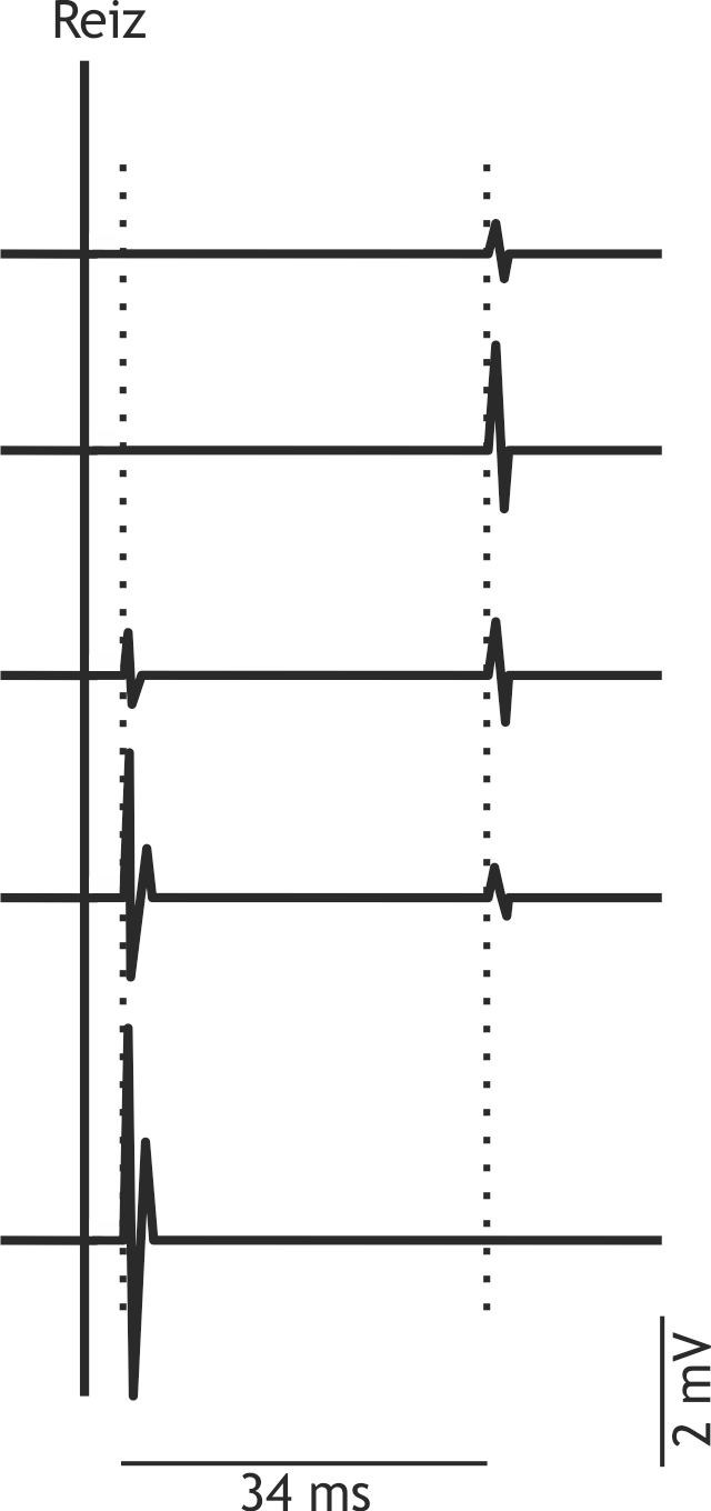 <p>21. Ms. M. has had type 1 diabetes mellitus for years, which in affected patients often leads, among other complications, to peripheral nerve damage. Therefore, her diabetologist orders annual measurements of nerve conduction velocity. In the given example, the tibial nerve was electrically stimulated in the popliteal fossa. The diagram shows the electromyogram (EMG) recorded from the triceps surae muscle at increasing stimulus strength.</p><p>Approximately how great is the mean nerve conduction velocity in the corresponding axons, if synaptic transmission of the reflex signal in the spinal cord takes about 2 ms, the distance from the popliteal fossa to segments L5–S2 is about 0.7 m, and the distance between the popliteal fossa and the EMG electrodes on the triceps surae muscle is about 0.2 m?</p><p>A. 5 m/s</p><p>B. 10 m/s</p><p>C. 25 m/s</p><p>D. 50 m/s</p><p>E. 100 m/s</p>
