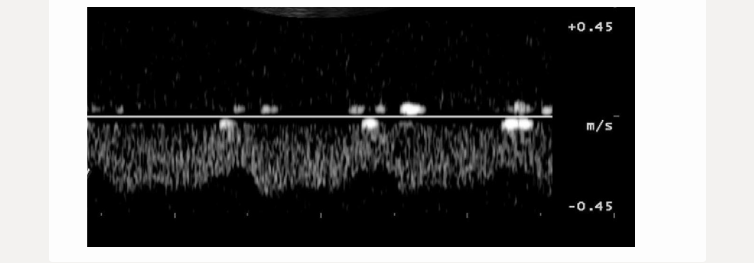 <p>the waveform from an abdominal vessel displays what 2 characteristics </p><p>.</p><p>a) flow reversal during augmentation</p><p>b) flow reversal during diastole</p><p>c) mild phasicity + pulsatility</p><p>d) triphasic flow + no respiratory variation</p>