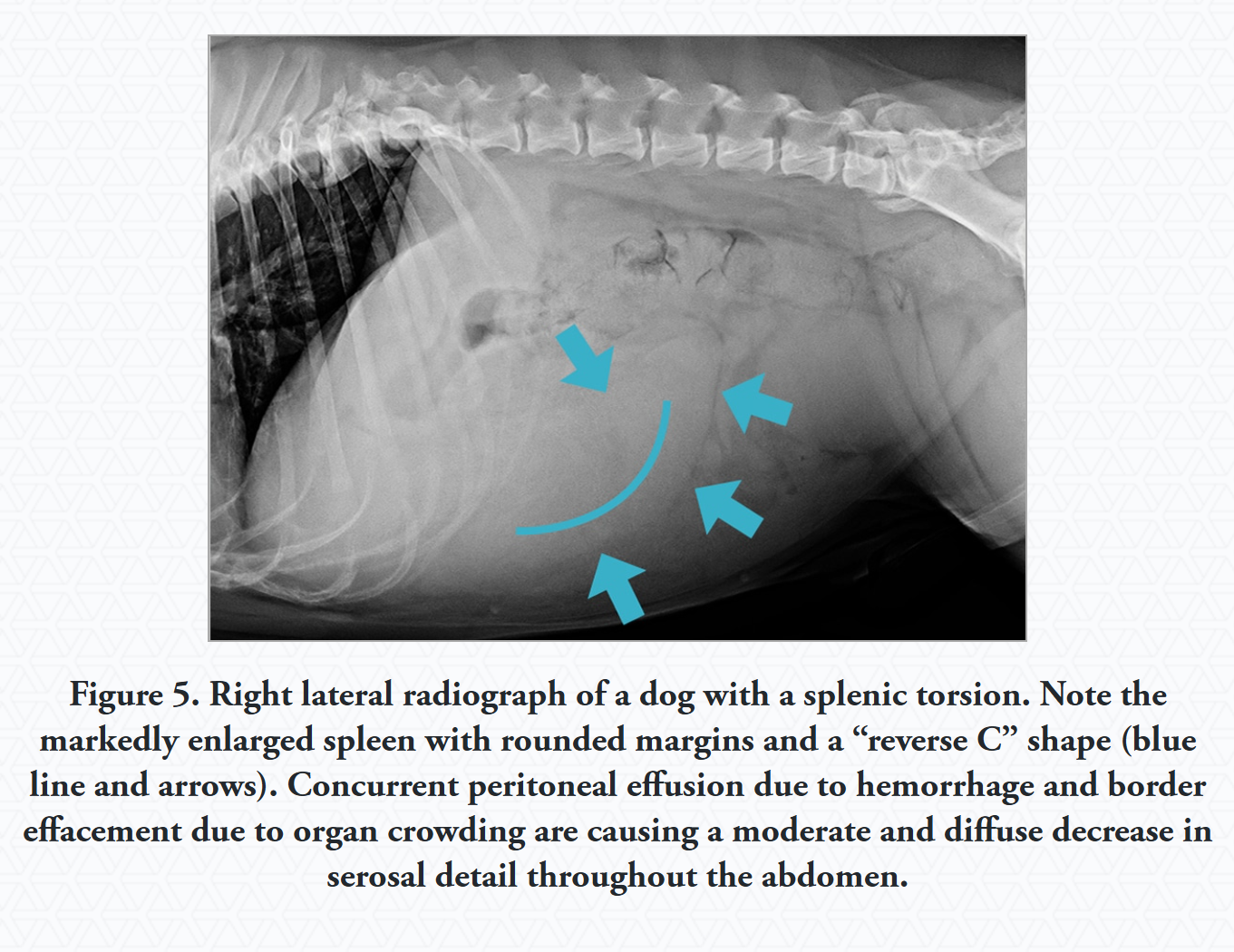 <p>Missing splenic silhouette or a C-shaped appearance.</p>
