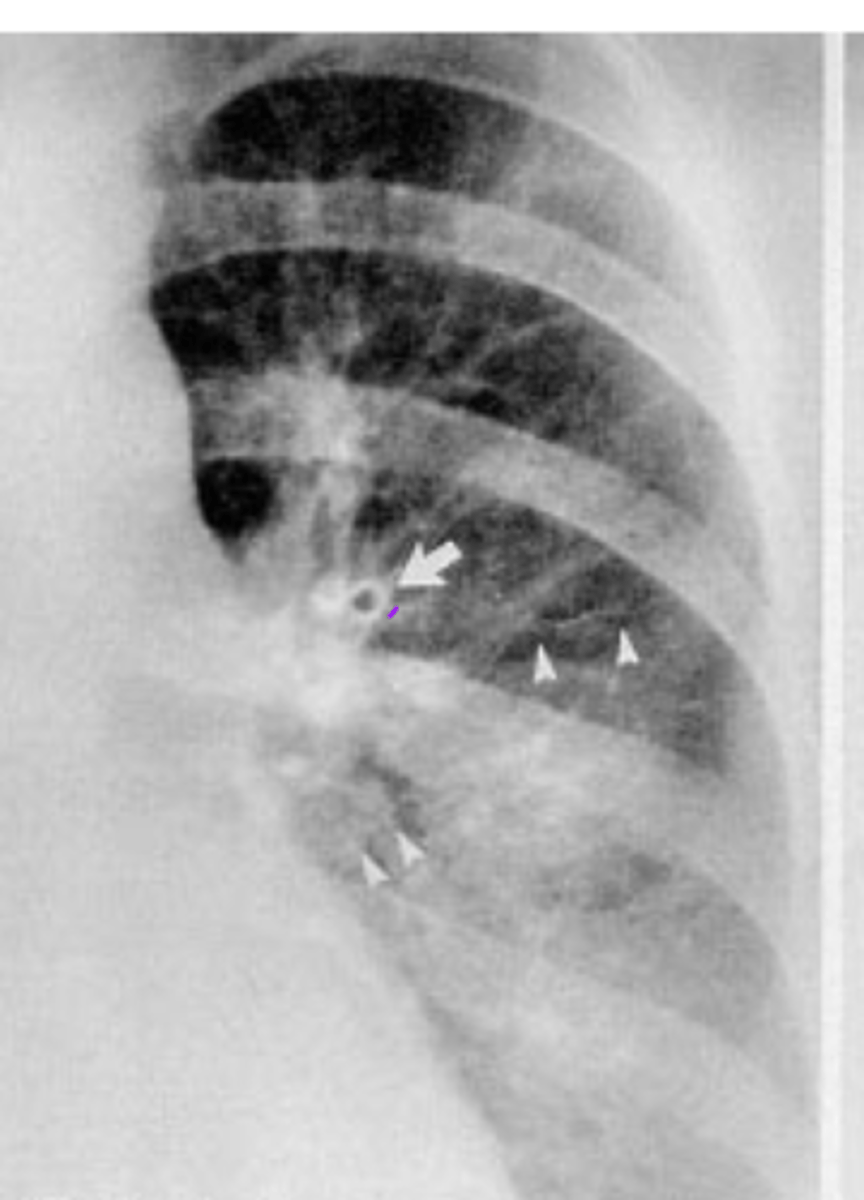 <p>what is this called and what causes it</p>