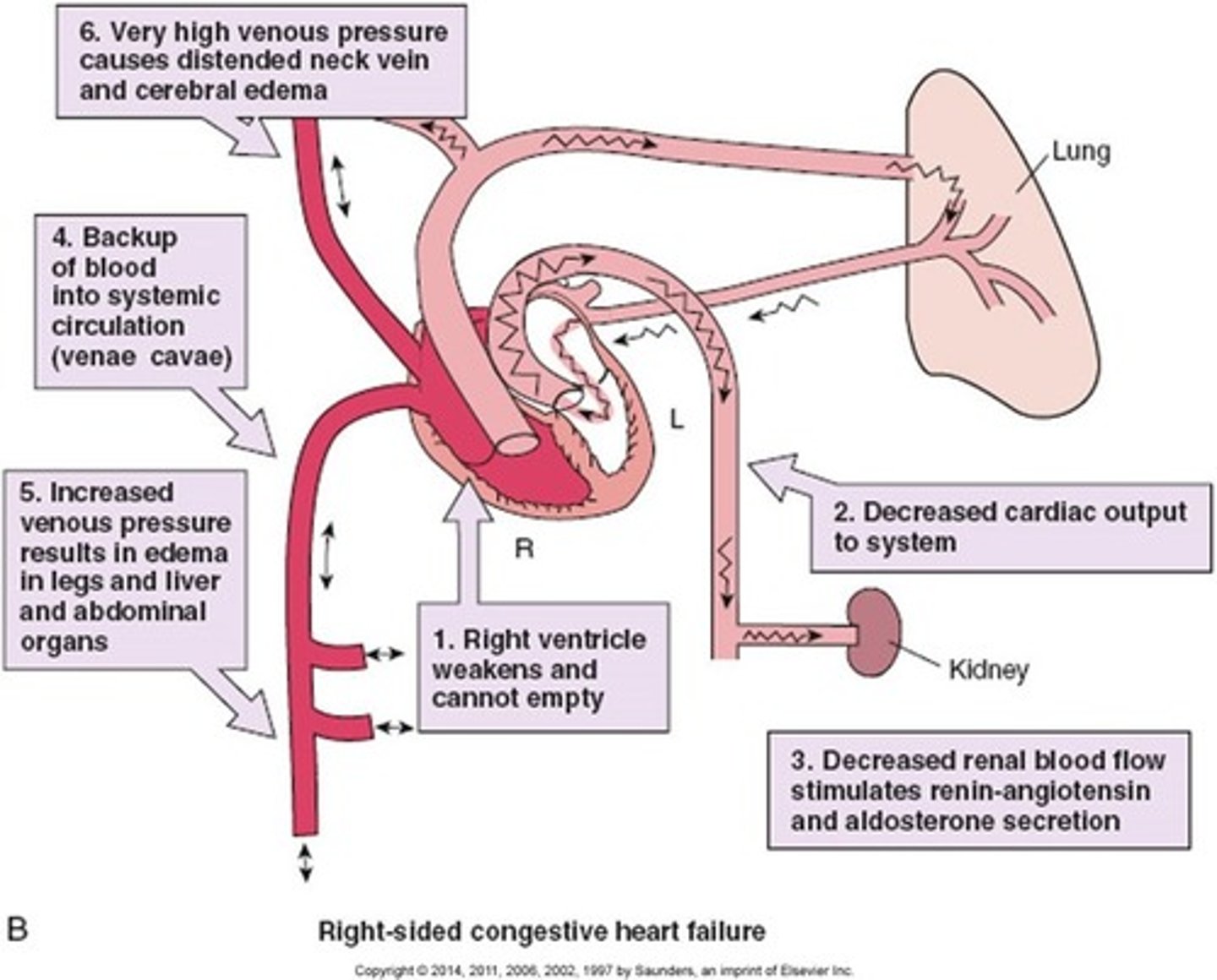 <p>Characterized by Systemic Congestion/Edema</p><p>Fluid builds up in the Body</p>
