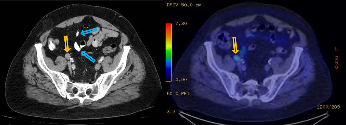 <p>Patient history: follow-up study in a patient with colorectal tumor </p><p>Modality: left – contrast-enhanced CT scan, venous phase, soft tissue window (iv. and oral iodine-based contrast agent); right – PET-CT, iv. 18-FDG (fluorodeoxyglucose) radiotracer </p><p>Region: pelvis, axial views </p><p>Radiologic sign: Pathological (16 mm shorter diameter) lymph node in the right parailiac region (yellow arrow). In the same localization, increased FDGuptake can be observed on PET-CT scan 10 days later (yellow arrow). Oral contrast agent containing bowel loops are marked with blue arrows. </p><p>Diagnosis: FDG-avid, pathological lymph node, suspicious for metastasis. </p>