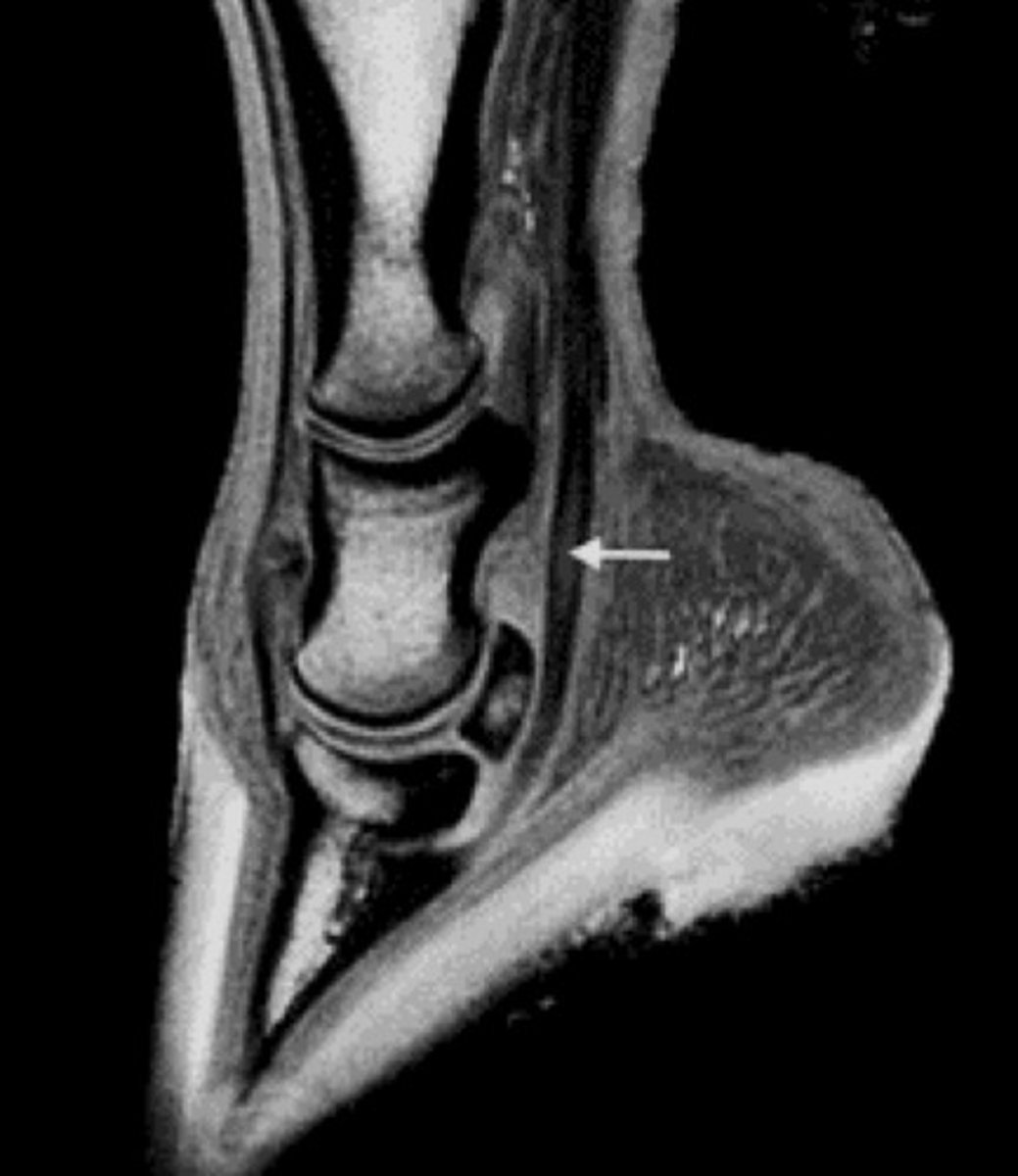 <p>What type of lesion is pictured? What structure is it present in?</p>