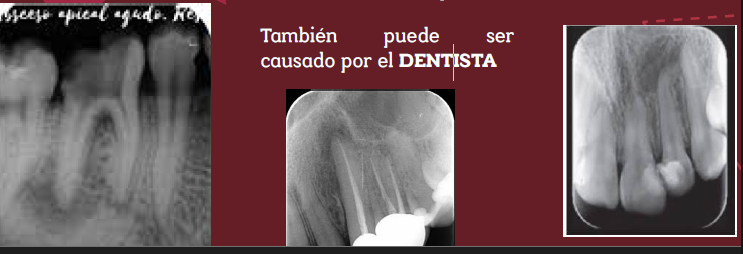 <p>Es causado principalmente por la progresividad de la CARIES al complejo pulpar</p><p>Traumas dentales</p><p>Enfermedad periodontal</p><p>También puede ser causado por el dentista</p>