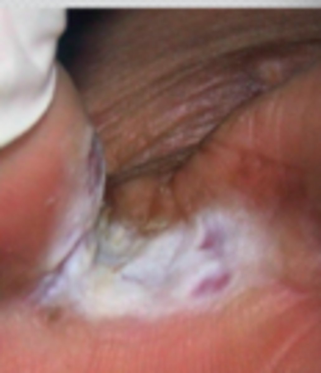 <p>Fungal Skin Infections:</p><p>Type of Tinea Pedis:</p><p>- maceration, peeling, fissuring of toe webs</p>