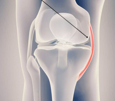 <p>A ligament in the knee that connects the femur to the tibia on the inner side, providing stability and support against lateral forces. </p>