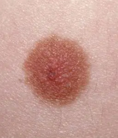 <p>Common Skin Variation</p><ul><li><p>Pigments on the skin</p></li><li><p>Usually flat or raised</p></li></ul><p></p>