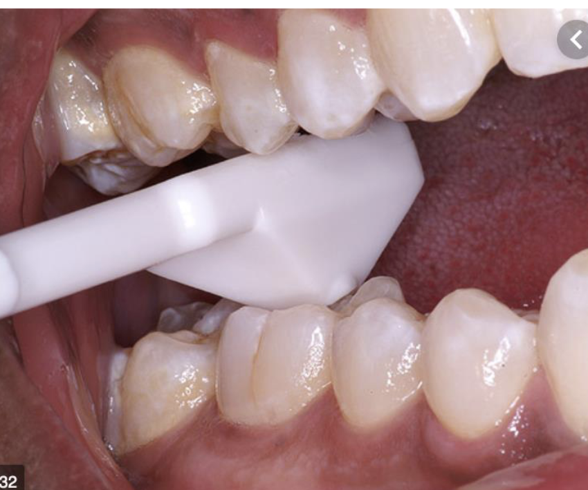<p>bite test (tooth slooth)/occlusal test (marking paper)</p>